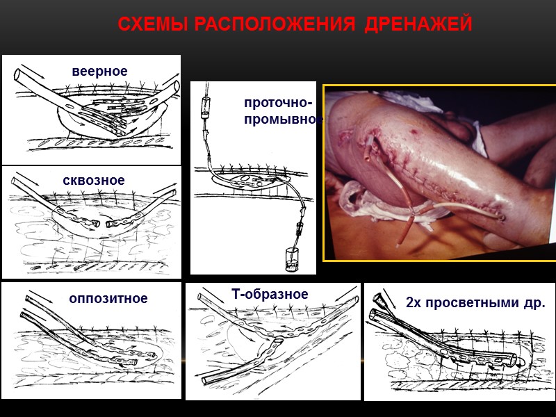 СХЕМЫ РАСПОЛОЖЕНИЯ  ДРЕНАЖЕЙ веерное сквозное оппозитное Т-образное 2х просветными др. проточно-промывное